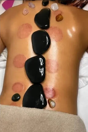Ventosaterapia com pedras quentes nas costas